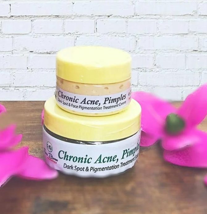 Acne Herbal Soap and Lotion The TJCollectibles