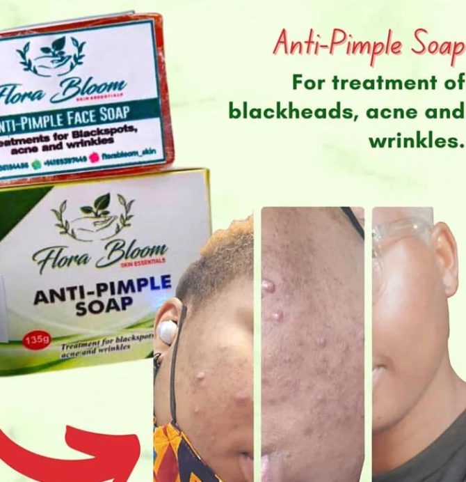 AntiPimples Soap The TJCollectibles