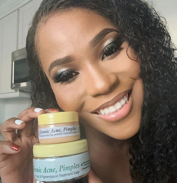 Acne Face Cream For Chronic Acne and Pimples The TJCollectibles